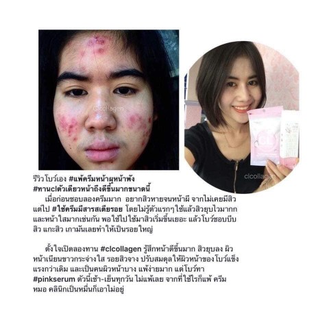 CL Collagen 12 ซีแอล คอลลาเจน ทั้งผิวใสและลดสิว  สวยครบจบในตัวเดียว รูปที่ 5