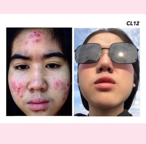 CL Collagen 12 ซีแอล คอลลาเจน ทั้งผิวใสและลดสิว  สวยครบจบในตัวเดียว รูปที่ 6