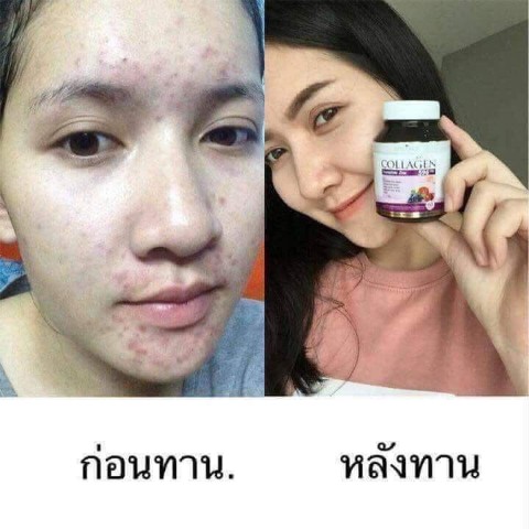 Collarich Collagen อาหารเสริมสำหรับผิวที่ดีที่สุด ช่วยลดสิว  ผิวกระจ่างใส รูปที่ 5