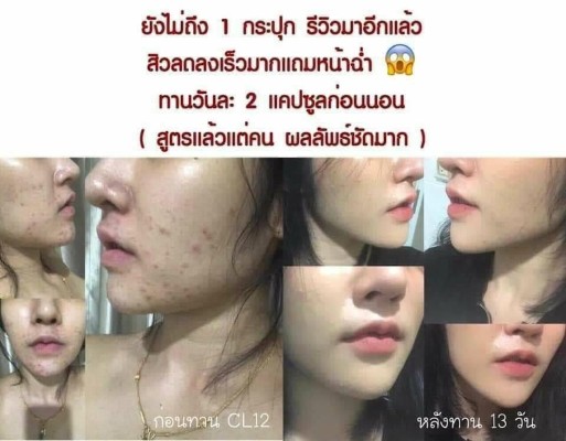 CL Collagen 12ซีแอล คอลลาเจน ตัวช่วยให้ผิวใสและลดสิว  สวยครบจบในตัวเดียว รูปที่ 5