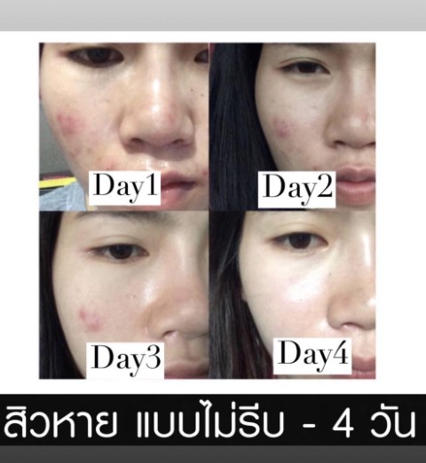 CL collagen ผิวสวยหน้าใส ลดสิว  เป็นคอลลาเจนที่ขายดีมาแรงสุด รูปที่ 4