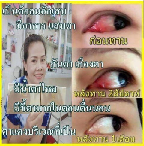 อาหารเสริมดวงตา ดีคอนแทค D contact ช่วยแก้ปัญหาตามัว เห็นภาพพร่า  ไม่แจ่ม มองไม่ชัด รูปที่ 6