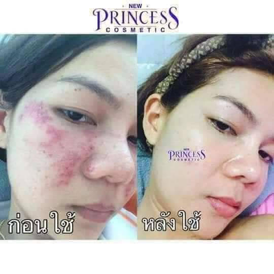 New Princess Cosmetic สิว ฝ้ากระ หน้าหมองคล้ำ  แพ้สาร หน้ากระจ่างใส นิวปริ๊นเซสก็จัดการได้  รูปที่ 7