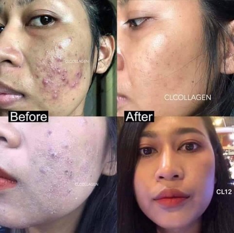CL Collagen 12 ซีแอล คอลลาเจน ตัวช่วยให้ผิวใสและลดสิว  สวยครบจบในตัวเดียว รูปที่ 5