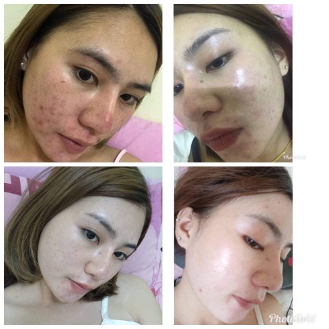 CL Collagen12 ซีแอล คอลลาเจน  ตัวช่วยให้ผิวใสและลดสิว สวยครบจบในตัวเดียว รูปที่ 5