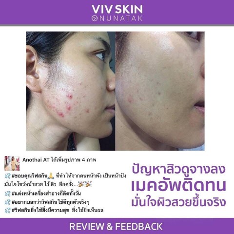 ผิวหน้าสวยใส รักษาสิวกับ จุ๋ย วรัทยา เคล็ดลับผิวใส ที่ใครๆก็อยากรู้ จุ๋ยเห็นว่าดี  ถึงกล้ามาบอกต่อ รูปที่ 5