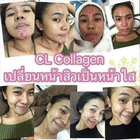 CL12 collagen ซีแอล คอลลาเจน ทั้งผิวใสและลดสิว สวยครบจบในตัวเดียว รูปที่ 4