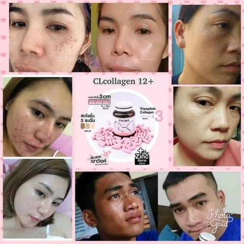 CL12 collagen ซีแอล คอลลาเจน ทั้งผิวใสและลดสิว สวยครบจบในตัวเดียว รูปที่ 5