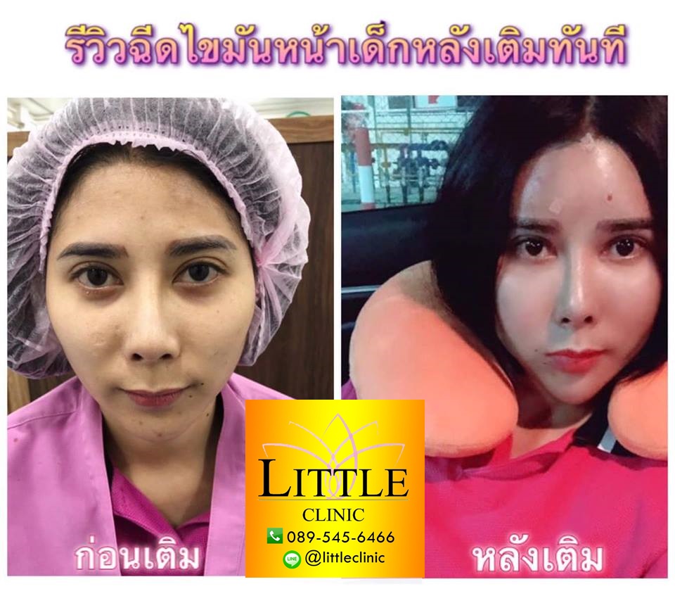เติมไขมันหน้า รูปที่ 2