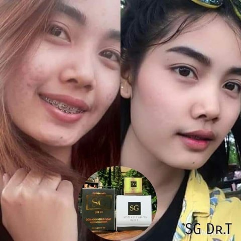 Stem Cell Gluta หน้าไม่ใส รูขุมขนกว้าง ฝ้าหนา กระฝังลึก ผิวหย่นคล้อย SG BY DR.T  ช่วยได้จ้า รูปที่ 4