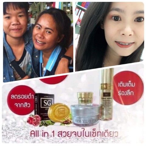 Stem Cell Gluta หน้าไม่ใส รูขุมขนกว้าง ฝ้าหนา กระฝังลึก ผิวหย่นคล้อย SG BY DR.T  ช่วยได้จ้า รูปที่ 1