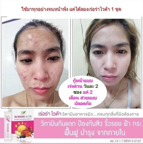 Rerrar Vita เร่อร่าไวต้า วิตามินอาหารผิว ลดเลือนริ้วรอย ผิวเต่งตึง ลดสิว  ผิวกระจ่างใส รูปที่ 6