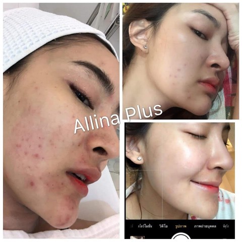 ออลิน่าพลัส Allinaplus วิตามินเร่งผิวขาว  เม็ดเดียวตอบสนองทุกความต้องการของผิว รูปที่ 7