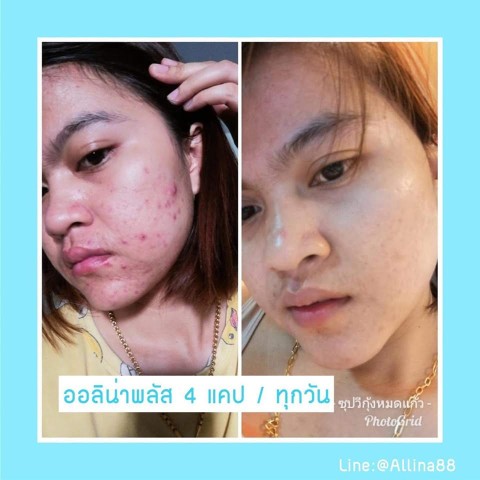 ออลิน่าพลัส Allinaplus วิตามินเร่งผิวขาว  เม็ดเดียวตอบสนองทุกความต้องการของผิว รูปที่ 6