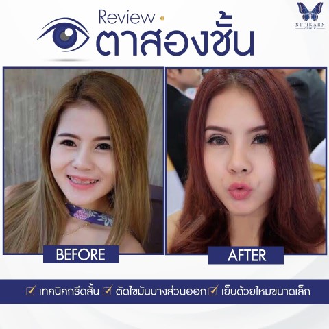 นิติกาญจน์ คลินิก บริการศัลยกรรมความงามโดยแพทย์ผู้เชี่ยวชาญ ปลอดภัย  รับประกัน 3 ปี รูปที่ 5