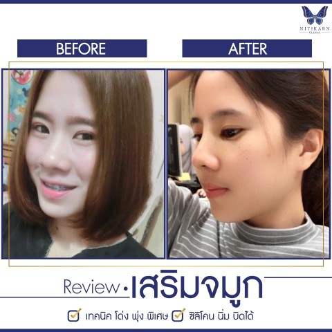 นิติกาญจน์ คลินิก บริการศัลยกรรมความงามโดยแพทย์ผู้เชี่ยวชาญ ปลอดภัย  รับประกัน 3 ปี รูปที่ 4