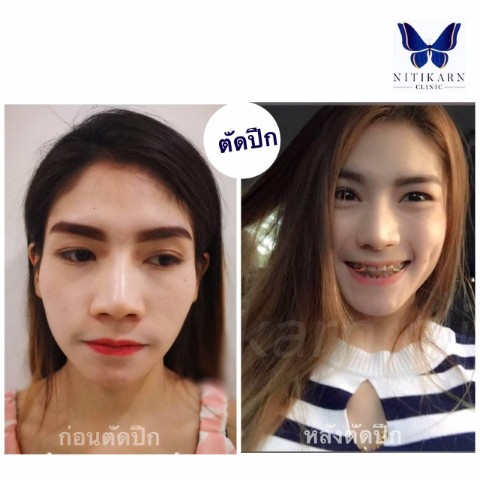 นิติกาญจน์ คลินิก บริการศัลยกรรมความงามโดยแพทย์ผู้เชี่ยวชาญ ปลอดภัย  รับประกัน 3 ปี รูปที่ 7