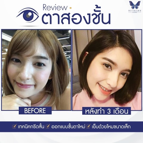 นิติกาญจน์ คลินิก บริการศัลยกรรมความงามโดยแพทย์ผู้เชี่ยวชาญ ปลอดภัย  รับประกัน 3 ปี รูปที่ 6
