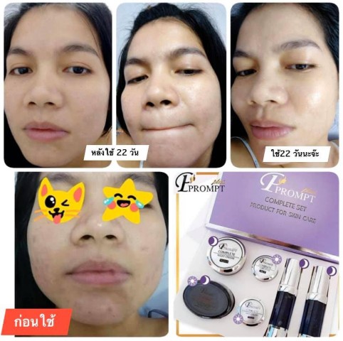 P Prompt Plus หน้าขาวใส ลด ฝ้า กระ สิว หน้าเรียวกระชับ ผิวกระจ่างใสภายใน7-14วัน รูปที่ 4