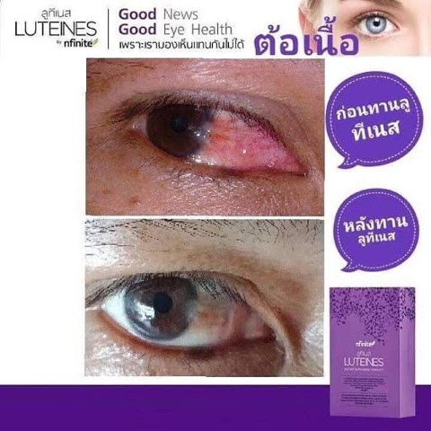 Luteines ลูทีเนส วิตามินบำรุงดวงตา ตอบโจทย์ทุกความต้องการ รูปที่ 7