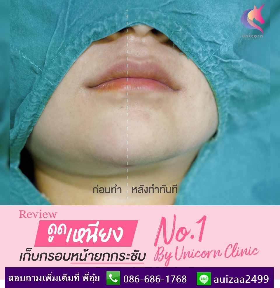 ดูดไขมันเหนียง รูปที่ 4