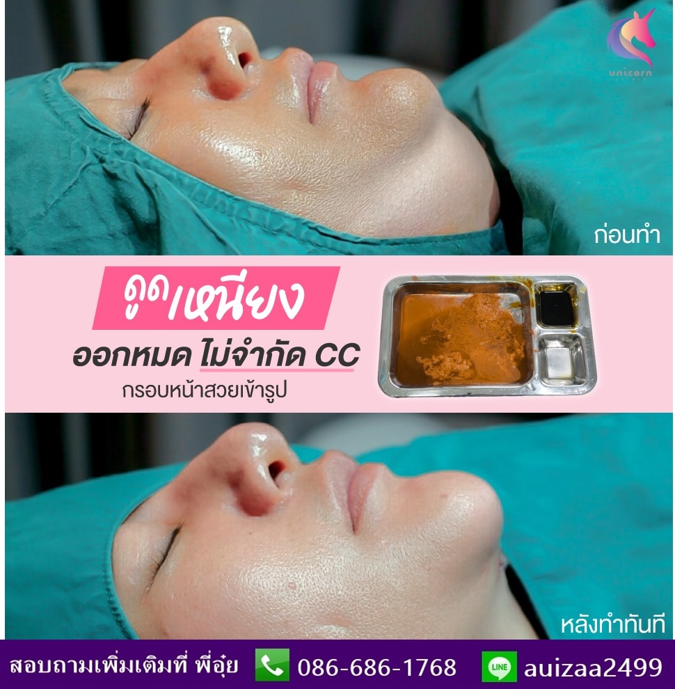 ดูดไขมันเหนียง รูปที่ 3