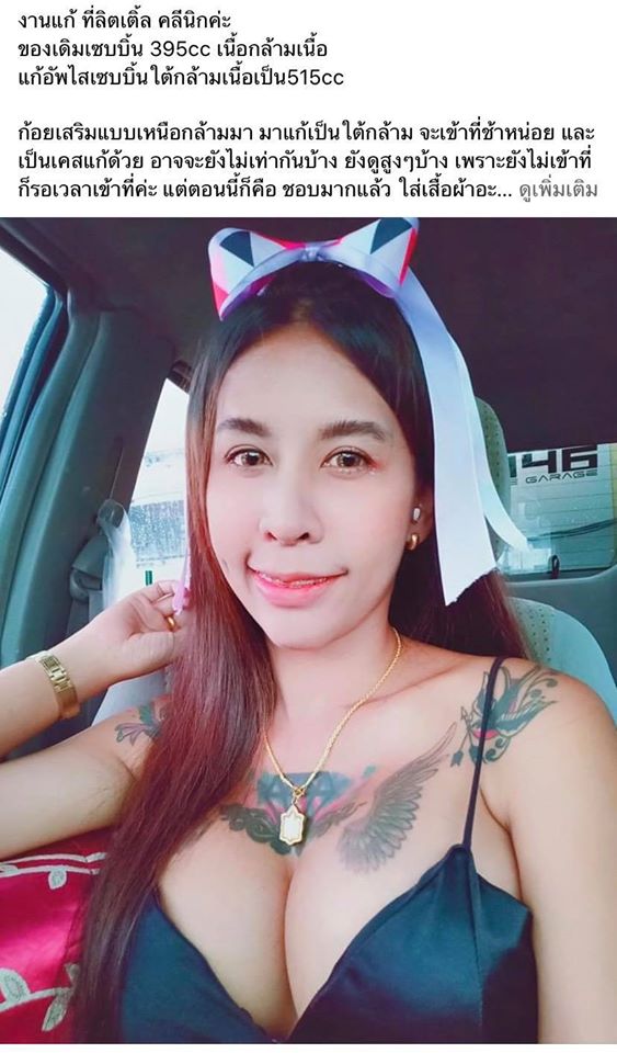 เสริมหน้าอกลิตเติ้ลคลินิก รูปที่ 4