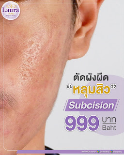 lauraclinic บริการรักษาหลุมสิวด้วยเลเซอร์ E-matrix เป็น ชื่อเครื่อง เลเซอร์รักษาหลุมสิว ที่เป็นที่นิยมที่สุดอันดับ 1 ของเมืองไทย รูปที่ 1