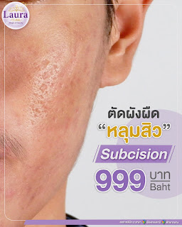 ลอร่าคลินิก บริการทำ subcision (ซับซีชั่น) คือการใช้ปลายเข็ม เข้าไปตัดผังผืดบริเวณใต้ฐานของหลุมสิว ด้วยเครื่อง E-matrix รูปที่ 1