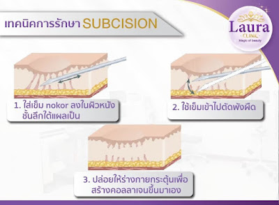 ลอร่าคลินิก บริการทำ subcision (ซับซีชั่น) คือการใช้ปลายเข็ม เข้าไปตัดผังผืดบริเวณใต้ฐานของหลุมสิว ด้วยเครื่อง E-matrix รูปที่ 1