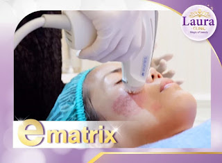 lauraclinic บริการรักษาหลุมสิวด้วยเลเซอร์ E-matrix เป็น ชื่อเครื่อง เลเซอร์รักษาหลุมสิว ที่เป็นที่นิยมที่สุดอันดับ 1 ของเมืองไทย รูปที่ 1