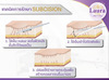 รูปย่อ ลอร่าคลินิก บริการทำ subcision (ซับซีชั่น) คือการใช้ปลายเข็ม เข้าไปตัดผังผืดบริเวณใต้ฐานของหลุมสิว ด้วยเครื่อง E-matrix รูปที่3