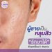 รูปย่อ lauraclinic บริการรักษาหลุมสิวด้วยเลเซอร์ E-matrix เป็น ชื่อเครื่อง เลเซอร์รักษาหลุมสิว ที่เป็นที่นิยมที่สุดอันดับ 1 ของเมืองไทย รูปที่2