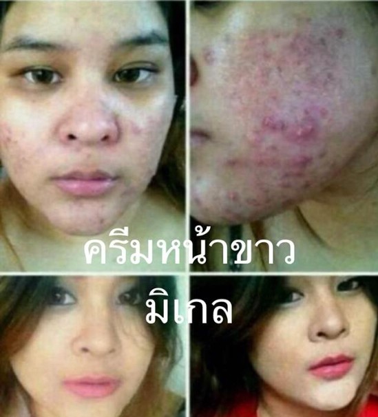 ครีมขมิ้นแก้ฝ้า รูปที่ 2