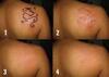 รูปย่อ Tattoo remover cream or gel in Cape Town+27 81 850 2816  รูปที่1