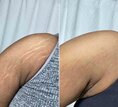 Remove body stretch marks in Soweto+27 81 850 2816