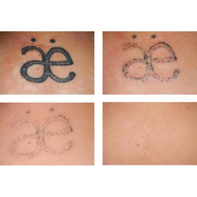 Tattoo remover cream or gel in Cape Town+27 81 850 2816  รูปที่ 3